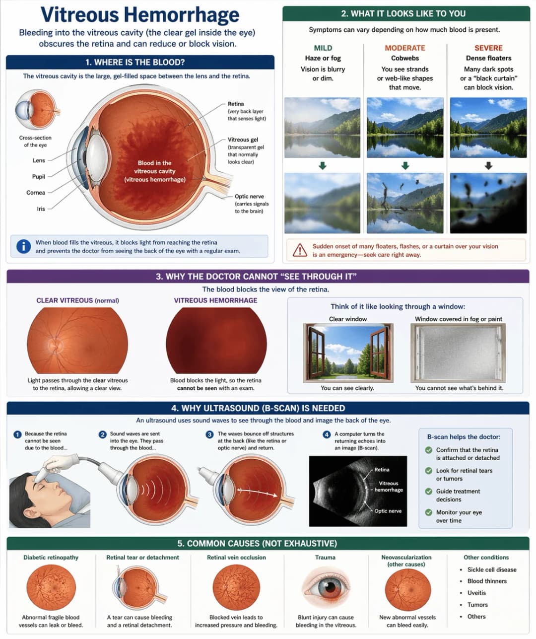 Infographic on vitreous hemorrhage: cross-sectional anatomy showing blood in the vitreous cavity between the lens and retina; patient-view simulations of mild haze, moderate cobweb floaters, and severe dense floaters or a black curtain blocking vision; side-by-side fundus photos of a clear vitreous versus a vitreous hemorrhage with a window analogy explaining why the doctor cannot see the retina; a four-step diagram of B-scan ultrasound to image through blood and check for retinal tears or detachment; and a summary of common causes including diabetic retinopathy, retinal tear or detachment, retinal vein occlusion, trauma, neovascularization, sickle cell disease, blood thinners, uveitis, and tumors