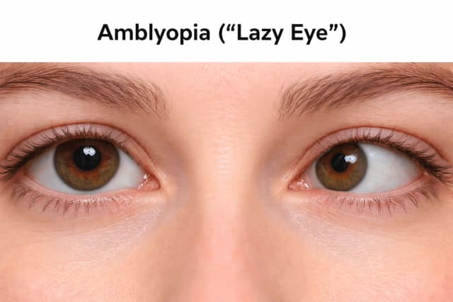 Close-up photo showing amblyopia - one eye appearing misaligned, illustrating lazy eye