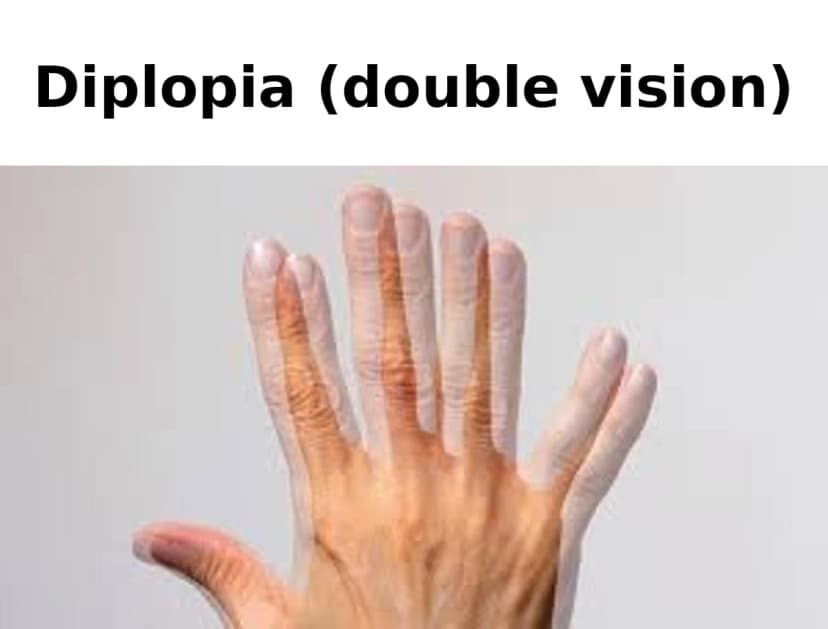 Illustration showing how double vision appears - two overlapping images of the same object
