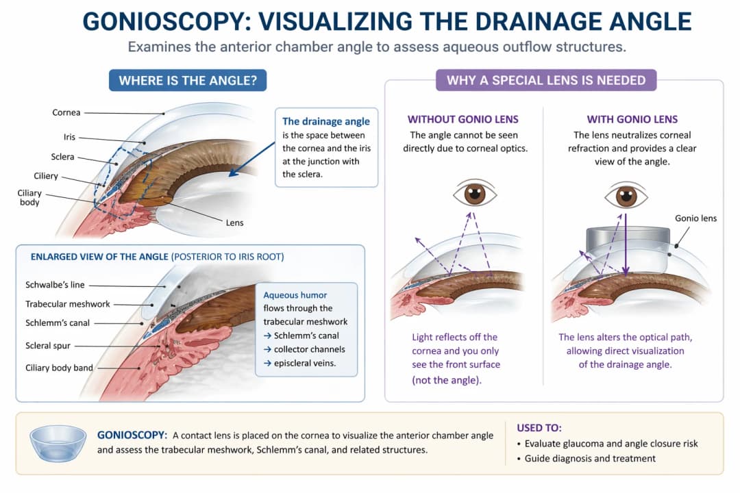 Infographic on gonioscopy and the anterior chamber angle: anterior-segment cross-section locating the drainage angle at the junction of the cornea, iris, sclera, and ciliary body, with an enlarged view labeling the key angle landmarks in order posterior to the iris root - Schwalbe's line, trabecular meshwork, Schlemm's canal, scleral spur, and ciliary body band - and showing that aqueous humor flows from the anterior chamber through the trabecular meshwork into Schlemm's canal, then out via collector channels to the episcleral veins; a side-by-side comparison explains why a goniolens is required - without it, total internal reflection at the corneal surface prevents direct visualization of the angle, while a contact gonio lens neutralizes corneal refraction and provides a clear direct view of the drainage angle used to evaluate glaucoma and angle-closure risk and guide diagnosis and treatment