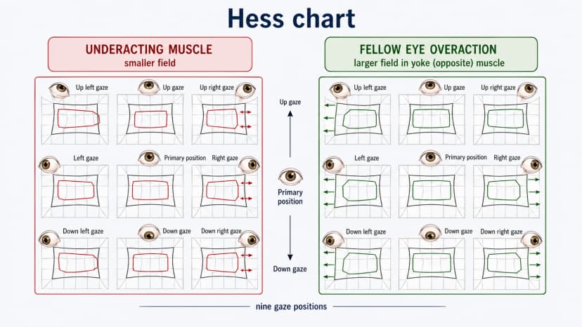 Hess chart diagram showing nine gaze positions, underacting muscle field shrinkage, and corresponding fellow eye overaction pattern