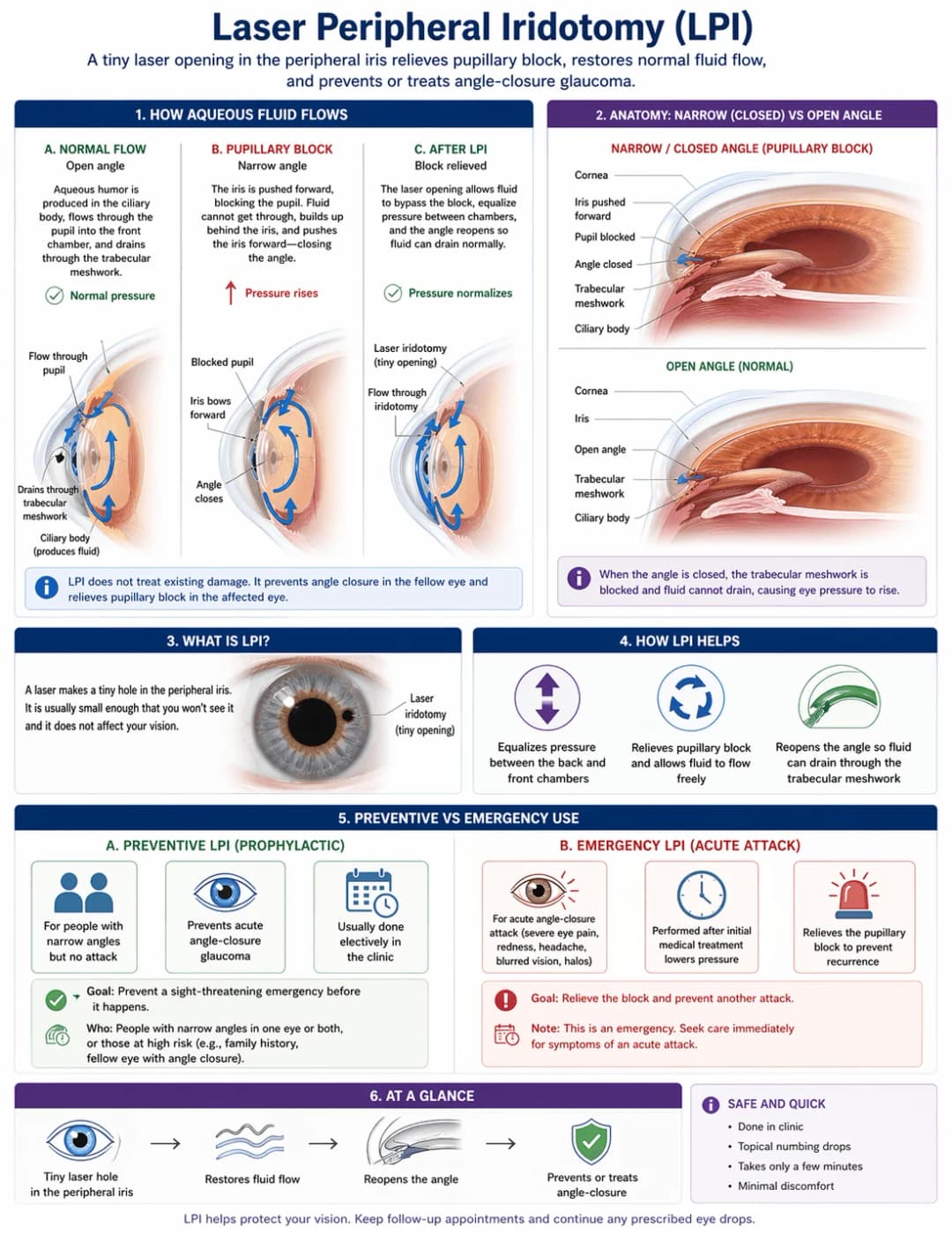 Infographic on laser peripheral iridotomy (LPI): diagrams of normal aqueous humor flow through the pupil and trabecular meshwork, pupillary block where the iris bows forward and closes the angle causing pressure to rise, and restored flow after LPI creates a tiny opening in the peripheral iris; anatomical cross-sections comparing a narrow or closed angle with pupillary block to a normal open angle; close-up of the iris showing the small laser iridotomy opening; how LPI helps by equalizing pressure between chambers, relieving pupillary block, and reopening the drainage angle; and preventive versus emergency use - prophylactic LPI in people with narrow angles to prevent acute angle-closure glaucoma, and emergency LPI after an acute angle-closure attack with eye pain, redness, headache, blurred vision, and halos