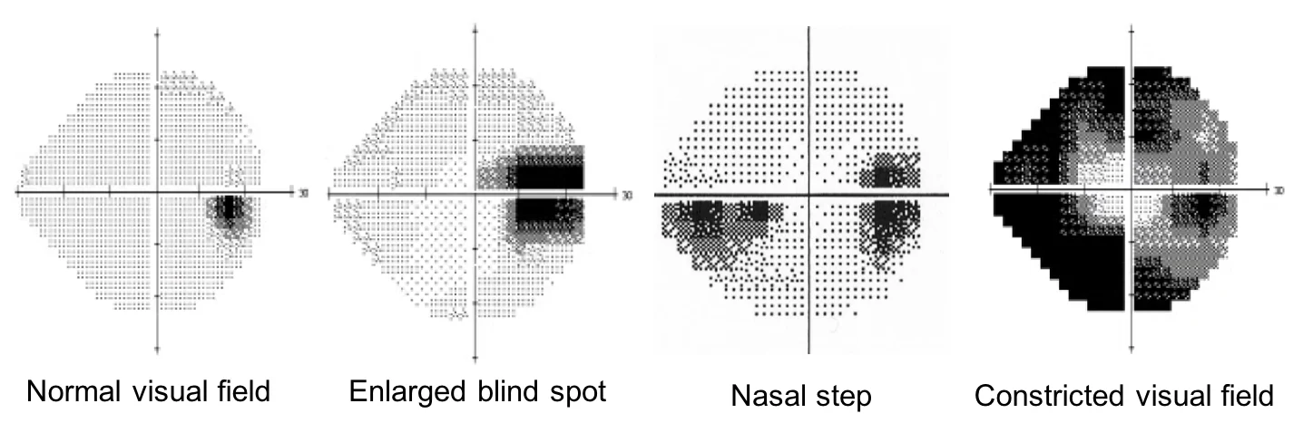 Visual field test progression in IIH showing four stages: normal visual field, enlarged blind spot, nasal step defect, and constricted visual field