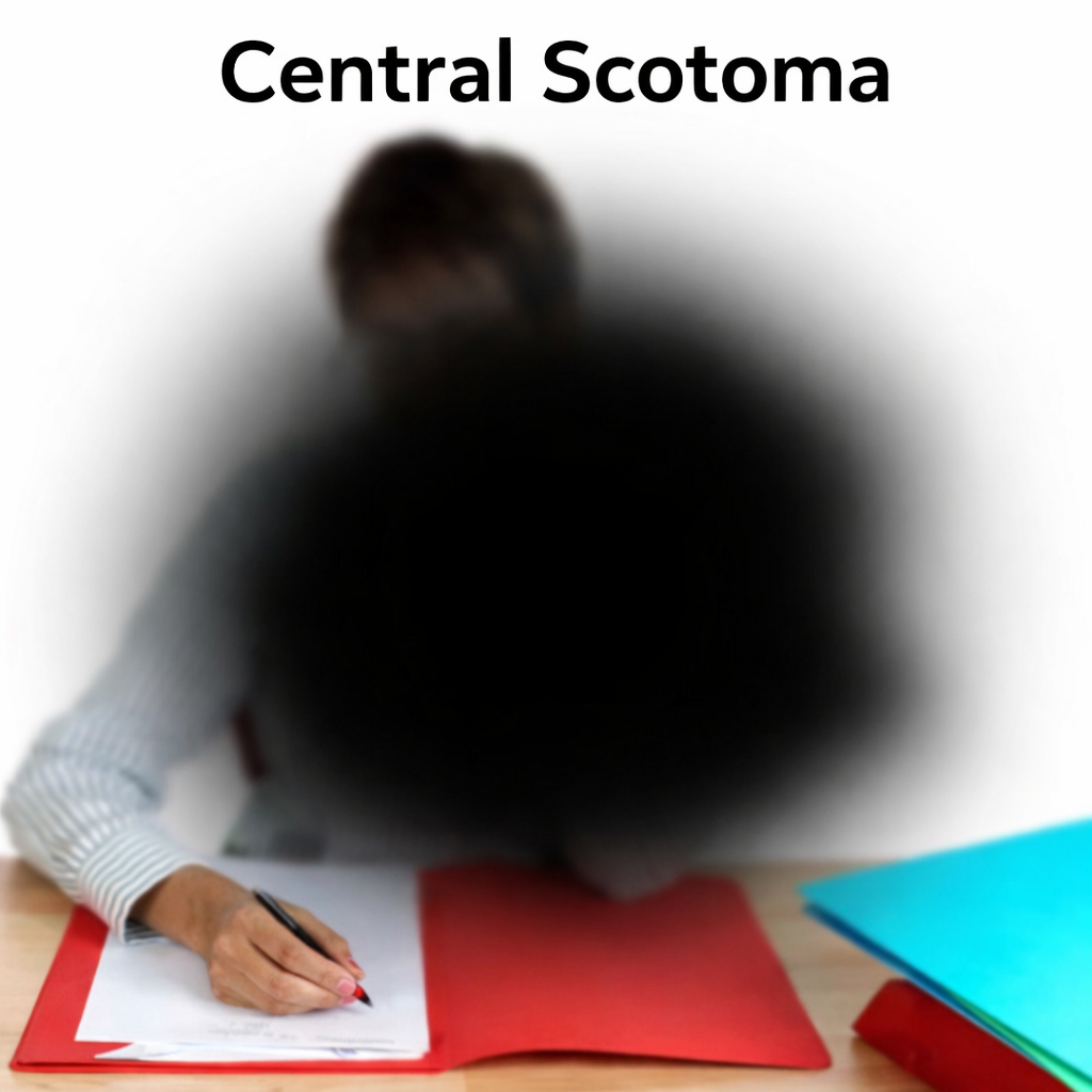 Illustration of central scotoma showing a dark blind spot in the center of vision
