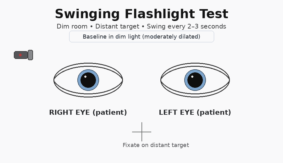 Animation of the swinging flashlight test showing pupil responses in both eyes