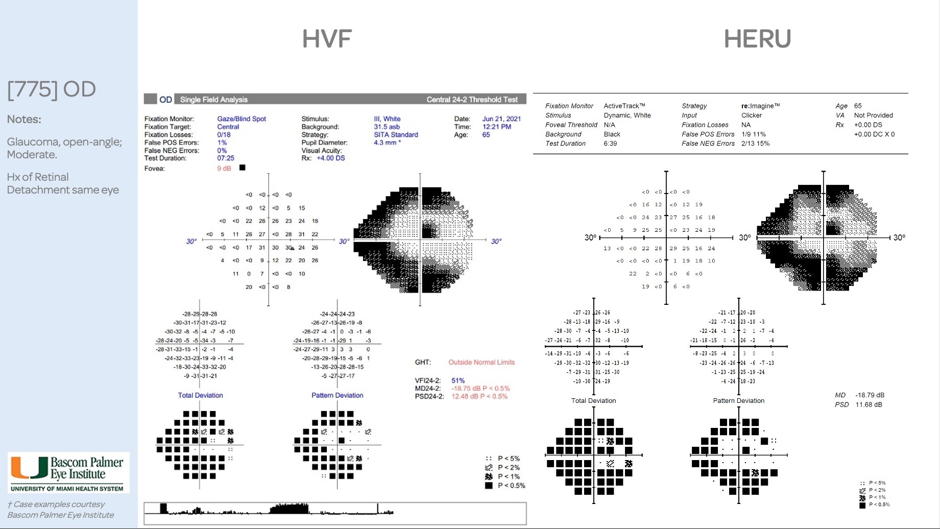 Example visual field test printout showing grayscale maps, numeric sensitivity values, total deviation, and pattern deviation plots